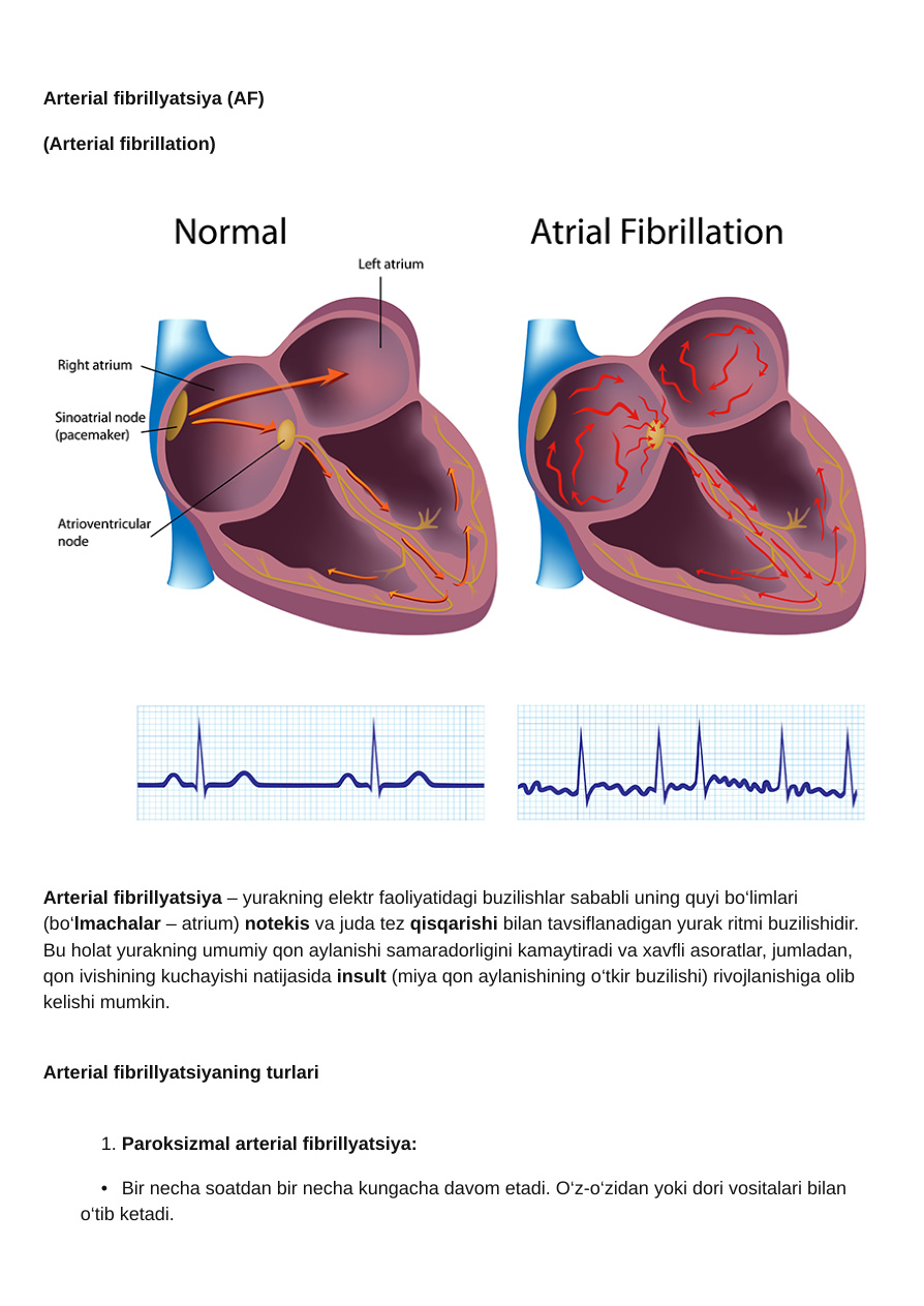 Arterial Fibrilatsiya