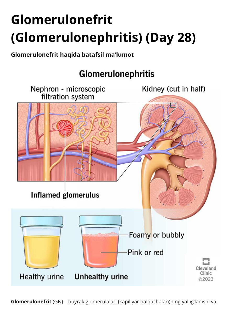 Glomerulonefrit (Glomerulonephritis) (Day 28)