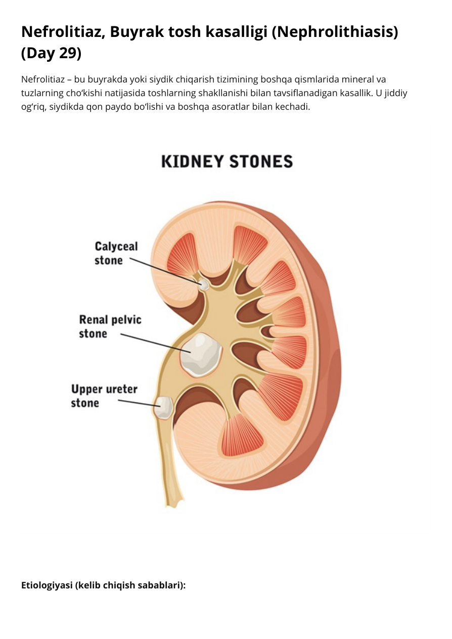 Nefrolitiaz, Buyrak tosh kasalligi (Nephrolithiasis)